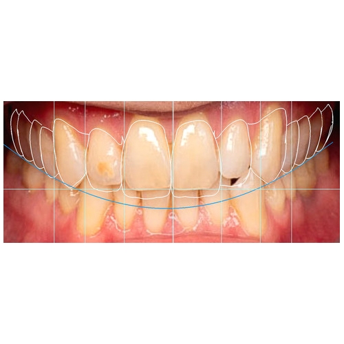 EXOCAD moduł SMILE CREATOR wersja Flex